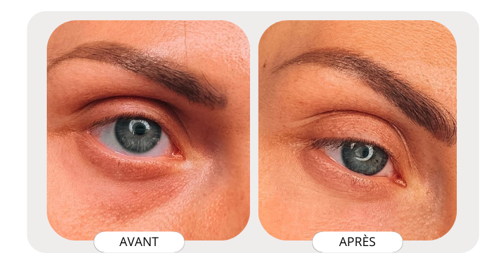 Patch Contour des Yeux