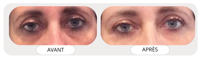 Patch Contour des Yeux